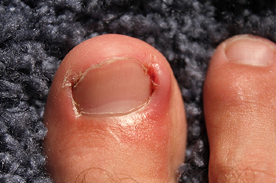 Wedge resection and nail bed ablation for ingrown toenails - Kerry Skin  Clinic