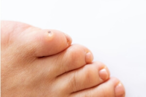 Symptoms, Causes and Risk Factors for Corns