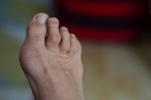 Differences Between Hammer Toes and Claw Toes